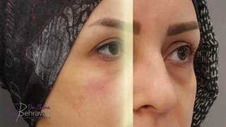 تزریق فیلر زیر چشم