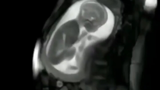 فیلم سونوگرافی حرکات جنین در شکم مادر