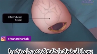 انیمیشن زیبای زایمان سزارین