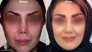 جراحی ترمیمی بینی | دکتر باستانی نژاد