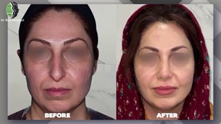 جراحی بینی استخوانی با افتادگی شدید نوک بینی | دکتر باستانی نژاد