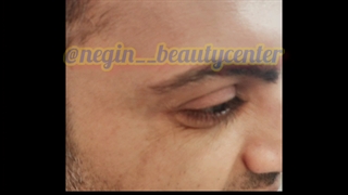 تزریق بوتاکس کره ای و ایرانی 09336093000 نگین گرگان