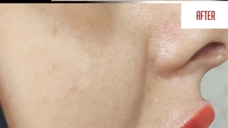 تزریق ژل لب در مرکز پزشکی نگین گرگان  09336093000