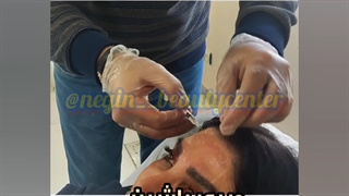 تزریق چربی در گرگان گنبد علی آباد 09336093000