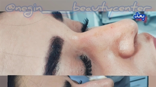 فیلر بینی و ژل بینی در نگین گرگان 09336093000
