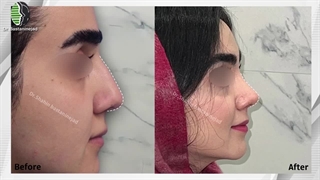 سه ماه پس از جراحی زیبایی بینی | دکتر باستانی نژاد