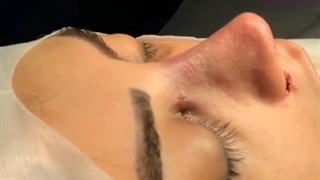 جراحی زیبایی بینی قبل و بلافاصله بعد از عمل