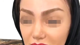 لیفت اندوسکوپیک ابرو و شقیقه