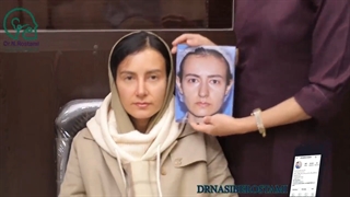 جراحی انحراف بینی