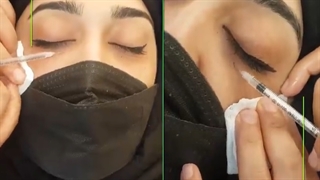 مزوتراپی زیر جشم