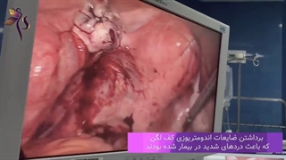 لاپاروسکوپی اندومتریوز