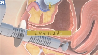کاربرد ها و مزایای لیزر واژینال