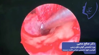 فیلم جراحی آندوسکوپیک اتواسکلروز-چسبندگی استخوانچه