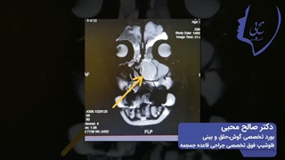 فیلم جراحی موکوسل شاخک میانی بینی