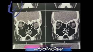 فیلم عمل دیسپلازی فیبرو  استخوان اتمویید