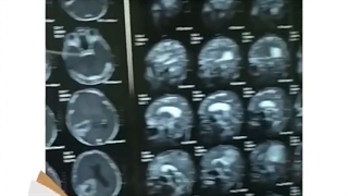 فیلم واقعی جراحی تومور مغزی بدخیم در اتاق عمل