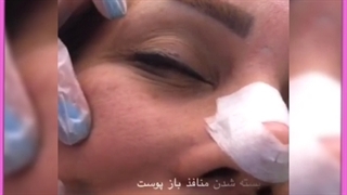 میکرودرم ابریژن روشی غیرتهاجمی برای جوانسازی پوست لیفت گردنایمپلنت دندان