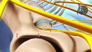 صحبت های دکتر قربانی مقدم در خصوص تصورات غلط بعد جراحی ستون فقرات