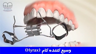 وسیع کننده کام (Hyrax) | دکتر احسان ابوئی مهریزی