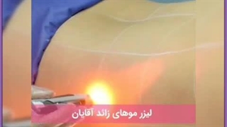 هزینه ، عوارض و مزایای لیزر موهای زائد برای آقایان