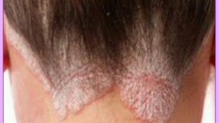 پسوریازیس ناخن چیست و چگونه آن را درمان کنم؟