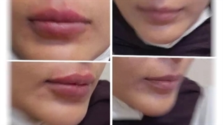 تزریق ژل لب