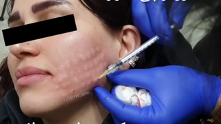 مزوتراپی صورت