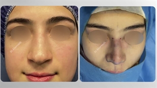 جراحی سپتورینوپلاستی | دکتر خوروش