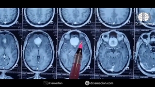 عمل جراحی مننژیوم اولفکتوری