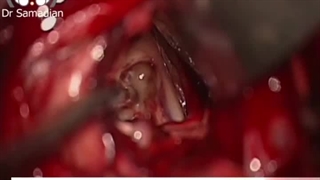 عمل جراحی میکروسکوپیک کیست کولویید بطن سوم با هیدروسفالی شدید