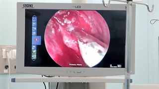 درمان گرفتگی بینی