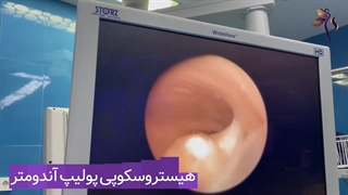 هیستروسکوپی پولیپ اندومتر