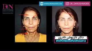 فیلم لیفت صورت، گردن و پیشانی