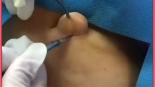 لیپوم یا غده چربی زیر پوست چیست ؟