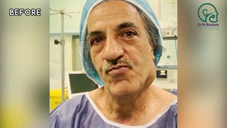 جراحی تومور پاروتید