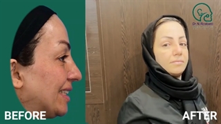 جراحی افتادگی و بینی همزمان