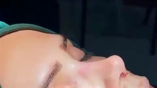 نمونه جراحی رینوپلاستی در کلینیک دکتر سعید شیرنگی
