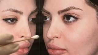 لایو جراحی بینی ترمیمی با تیپ افتاده بدون استفاده از غضروف دنده و گوش