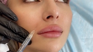 مراقبت های بعد از تزریق ژل کامپوزیت ونیر