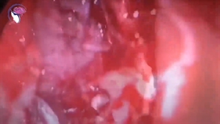 جراحی سینوزیت مزمن و پولیپ بینی در دختر 15 ساله