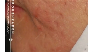 سابسیژن جای جوش