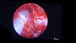 فیلم بدون سانسور جابه جایی چشم به دلیل عفونت سینوس