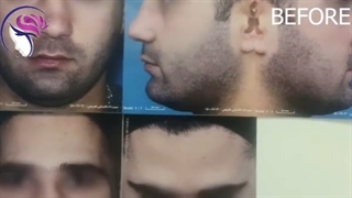 قبل و بعد جراحی زیبایی بینی مردانه