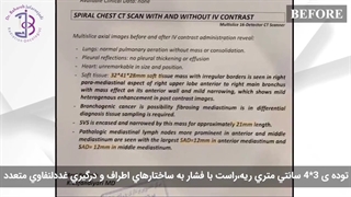 نمونه ی واقعی از درمان سرطان ریه!