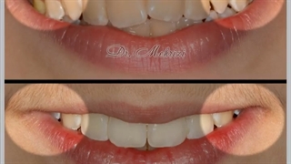 افزایش عرض لبخند | دکتر احسان ابوئی مهریزی