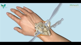 فیلم از جراحی مچ دست