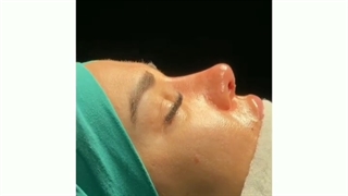 جراحی بینی دکتر سهراب مرادی