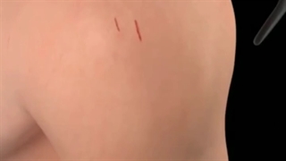 فیلم ترمیم پارگی ارتوسکوپی