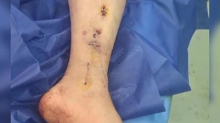 فیلم واقعی از جراحی پای خرد شده