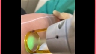 بهترین روش از بین بردن و حذف موهای زائد صورت و بدن خانگی و کلینیکی